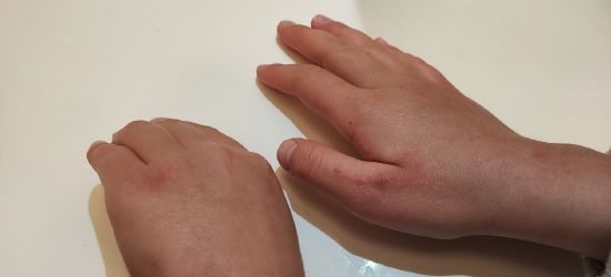 POSŁANKA PiS OSTRZEGA: Tak wyglądają ręce dziecka po tygodniu dezynfekcji w szkole (FOTO)